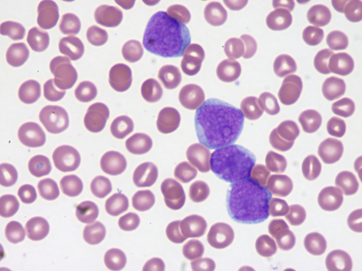 Initial peripheral blood blasts 60x